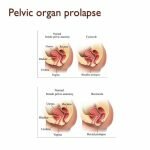 Pelvic Organ Prolapse Repair Device