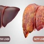 Fatty Liver Disease Drug Market